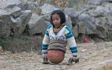 “Cô bé bóng rổ” mất nửa người 15 năm trước: Kinh ngạc với cuộc sống thay đổi hoàn toàn ở hiện tại
